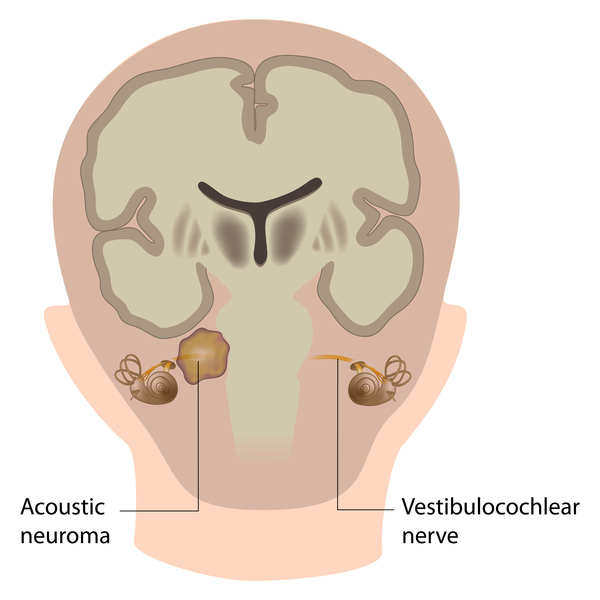 Neurofibromatosis Type 2: Recognising Cortical-and Retinal Dysplasia as Early Diagnostic Indicators