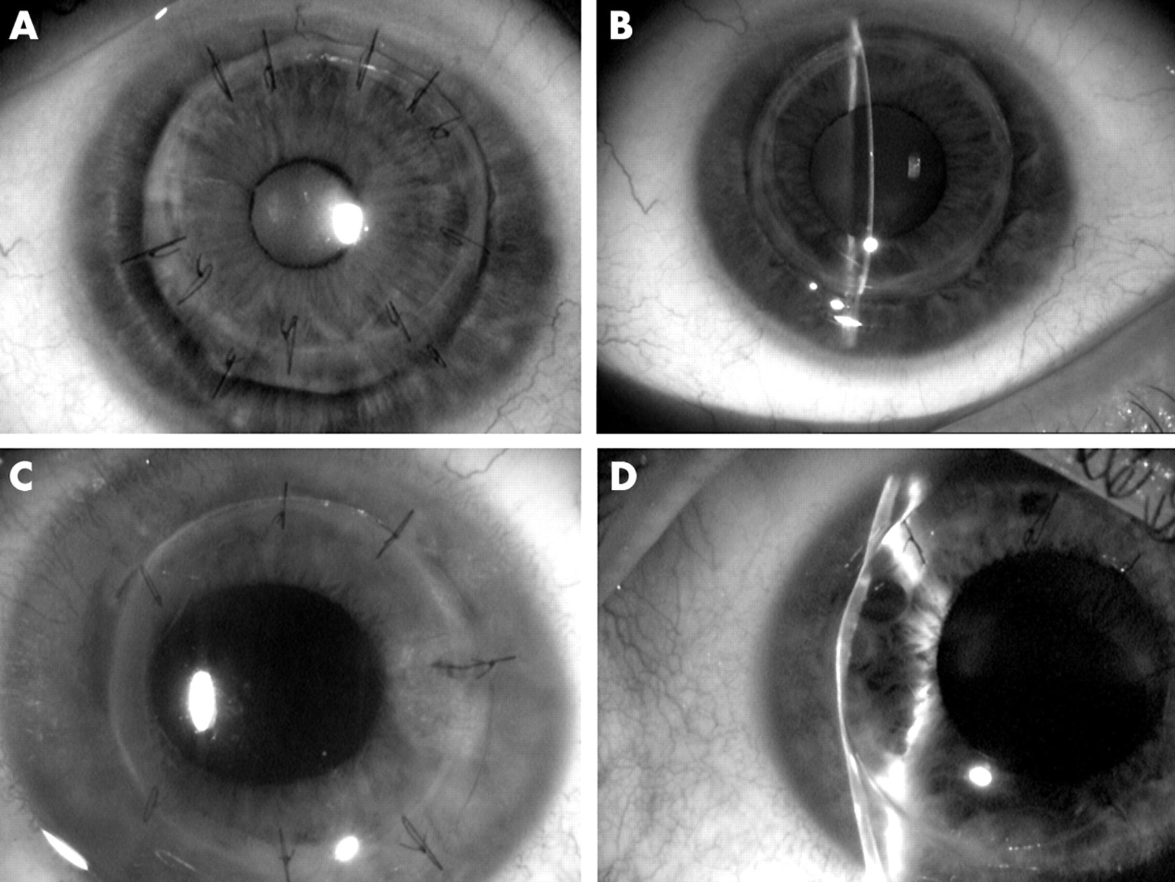 Relationship between Preoperative Corneal Thickness and Postoperative Visual Outcomes after Posterior Lamellar Corneal Transplant