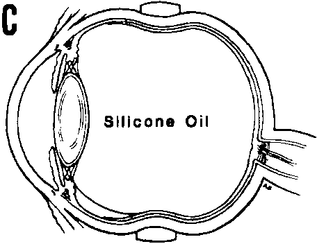 Pathological Features of Epiretinal Membranes in Silicone Oil Filled Eyes