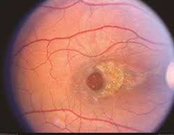 Surgery of an Idiopathic Macular Hole in the Eyes Accompanied by Dry, Age Related Macular Degeneration Own Results