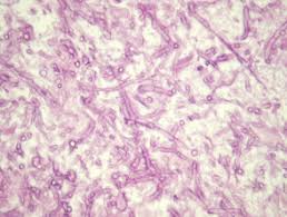 A fatal case of acute bilateral orbital apex syndrome with mucormycosis