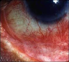 The Value of Conjunctival Immunohistochemistry Analysis for the Diagnosis of Ocular Mucous Membrane Pemphigoid