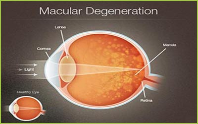 The Frequency of the Nonresponsiveness to Intravitreal Injection of the Anti-Vascular Endothelial Growth Factor Agent in Neovascular Age Related Macular Degeneration