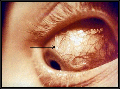 Ocular Loiasis in a Nigerian Female Adult