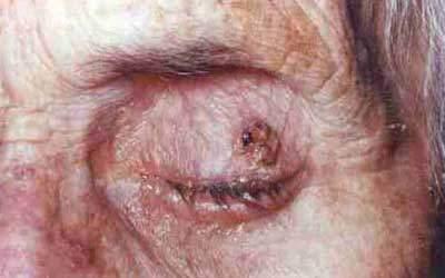 A Case Report: Extranodal Marginal Zone Lymphoma of the Eyelid