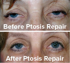 Oculoplastic Procedure Is a Type of Surgery Done Around the Eyes