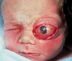 Congenital Orbital Teratoma: A Rare Presentation