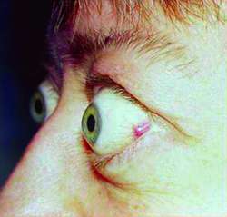 Exophthalmia as a First Manifestation of Epitheliod Hemangioma