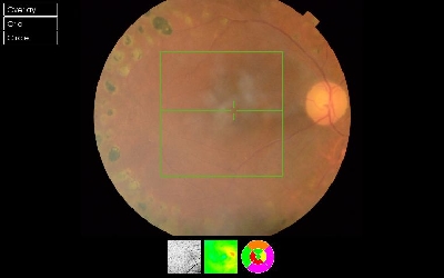 Ocular Manifestation of Chlorpromazine Toxicity- A Case Report