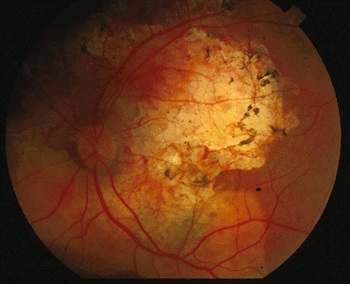 Multimodal Imaging in Two Cases with Choroidal Osteoma