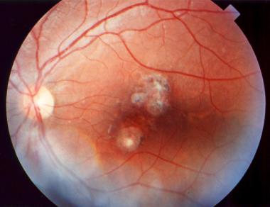 Unilateral Chorioretinal Finding: A Presumptive Diagnosis in a Case of 5 Years Ago Treatment of Extrapulmonary Tuberculosis