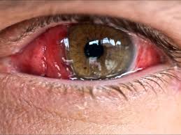 Conjunctival Kaposi Sarcoma Revealing HIV Infection