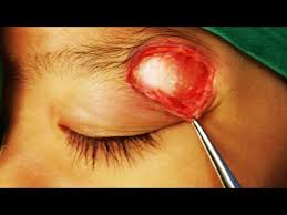 Orbital Solitary Fibrous Tumor: Report of a Three Cases Series