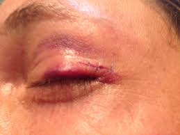 Multiple Tubular Adenoma Apocrine on Upper and Lower Eyelid