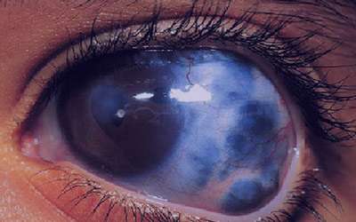 Acute Angle Closure Glaucoma as Initial Manifestation of Uveal Melanoma