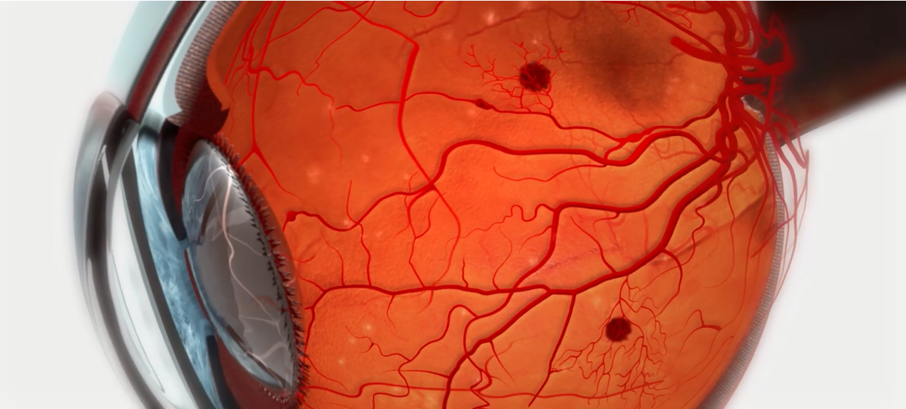 Interferon Associated Retinopathy in Chronic Hepatitis C: Two Cases Report
