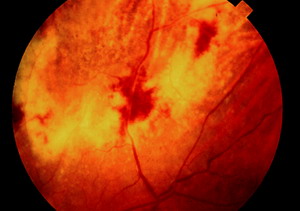 Acute Retinal Necrosis with Multiple Viral Infections: A Case Report