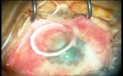 Cultured Human Keratocytes from the Limbus and Cornea Both Express Epithelial Cytokeratin 3: Possible Mesenchymal-Epithelial Transition