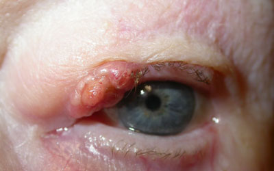 Incidence of Benign and Malignant Eyelid Tumors in Japan