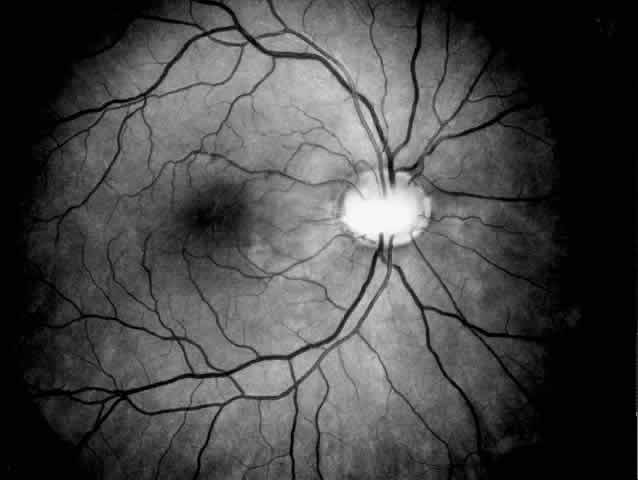 Peripapillary Retinal Nerve Fiber Thickness in Healthy French Children by Spectral-Domain Optical Coherence Tomography