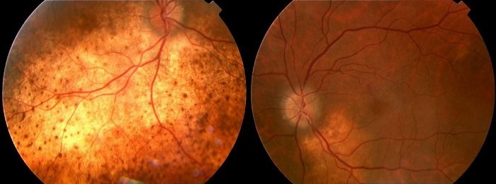 A Case of Choroidal Metastasis Determined to be Hepatocellular Carcinoma