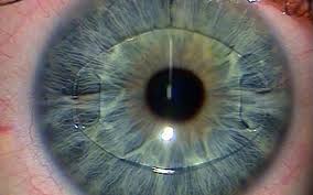 A Description of the Pathological Features of Rheumatoid Corneal Melt
Strategies