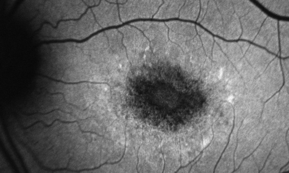 Bilateral Idiopathic Solitary Granuloma of the Uveal Tract: Diagnosis and Treatment