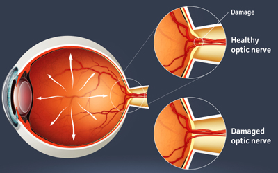 The Significance of Intraocular Pressure Alterations from Common Therapeutic Interventions: Preliminary Study with Clinical Implications