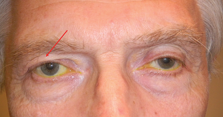 Stop Medication to Avoid Oculoplastic Surgery: Prostaglandin-Associated Periorbitopathy