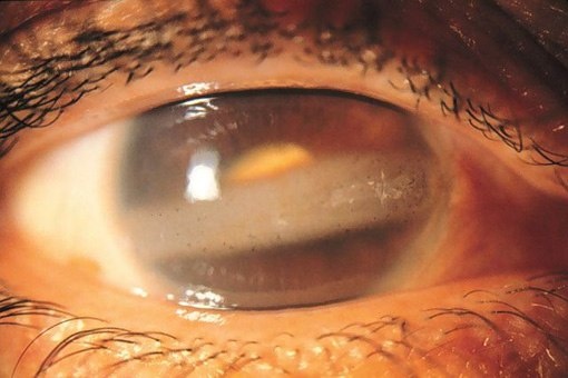 Cornea Verticillata: A Case Report