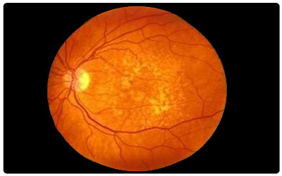 Interleukin-11: A Novel Agent in Retinal Ischemia-Reperfusion Injury