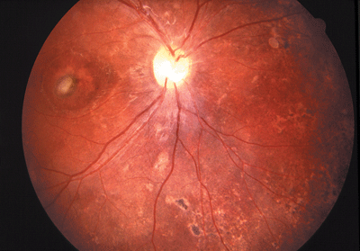 In-toto Removal of Sub- Retinal Cysticercosis and its Histopathology