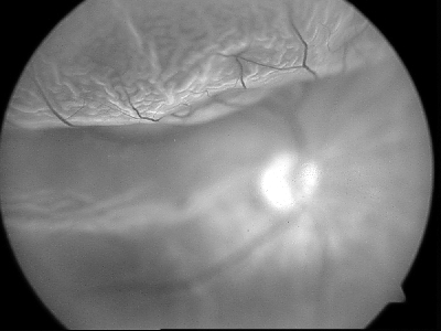 Unusual Case of an Orbital Lymphangioma Presenting as Chorioretinal Folds with Macular Involvement in an Elderly Patient