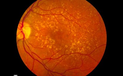 A Clinical Analysis of Age-Related Macular Degeneration in Qinghai Plateau