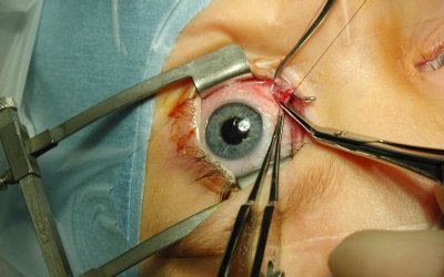 Clinicopathologic Correlation of 342 Surgical Eye Specimens: Comparison of 17 Consecutive Years (1999-2015)