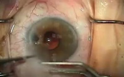 Spontaneous Resolution of Retinal Detachment Only After Barrage Laser Photocoagulation in a Patient with Inadvertent Scleral Perforation during Retrobulbar Anesthesia: A Case Report