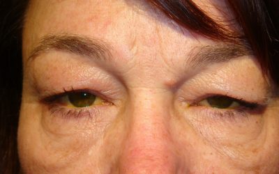 Complications Associated with the Surgical Techniques of Upper Eyelid Loading: A Clinicopathologic Study of 7 Explanted Gold Weight Lid Loads