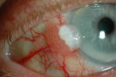 Conjunctival Seborrheic Keratosis Mimicking Ocular Surface Squamous Neoplasia