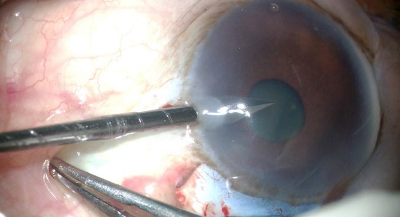 Push and Pull Method for Small Incision Cataract Surgery in Small Pupil: An Innovative Technique