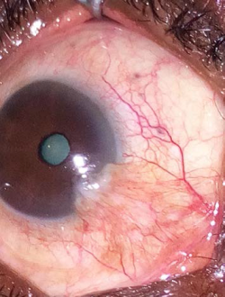 Demographic Characteristics of Ocular Surface Squamous Neoplasia in a Tertiary Hospital