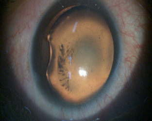 Endocapsular Ring Implantation for Traumatic Subluxated Cataract: Modified Techniques