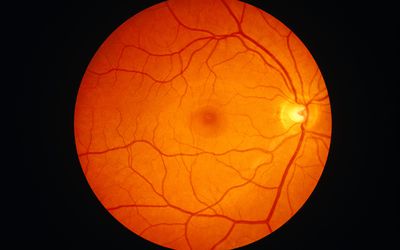 Three-year Outcomes of a Treat-and-Extend Regimen of Intravitreal Aflibercept for Wet ARMD at the Western Eye Hospital