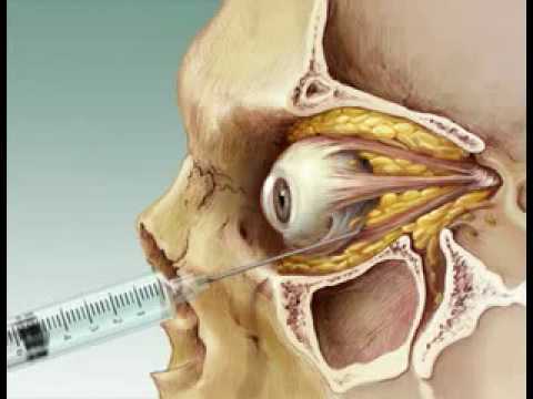 Relapsing Optic Neuropathy Followed by Optic Nerve Injury after Peribulbar Anesthesia – A Case Report