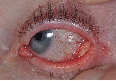 Xeroderma Pigmentosum- Diagnosis and Treatment of Two Different Ocular Tumors in Eyelid and Conjunctiva