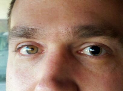 Subthreshold Micropulse Yellow Laser Treatment for Central Serous Chorioretinopathy