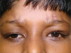 Frontalis Sling Surgery Using DCR Silicon Stents for Correction of Ptosis with Poor Levator Action: Single-Centre Experience from Saudi Arabia
