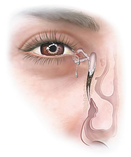 External vs. Endonasal Endoscopic Dacryocystorhinostomy: Surgical Success and Patient Satisfaction