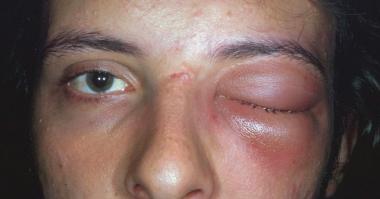 Primary Invasive Orbital Aspergillosis in an Immunocompetent Patient