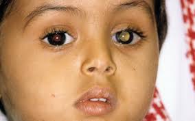 A Case of Retinal Dysplasia, Misdiagnosed as Retinoblastoma