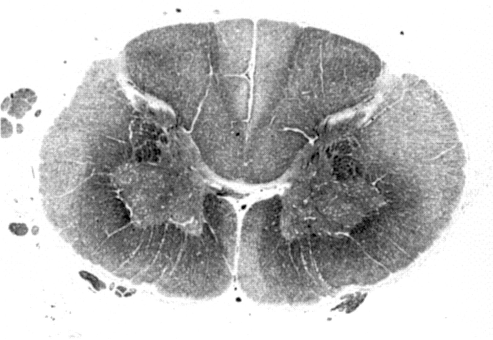 Computer-Aided Probing of the Pathogenic SNPs of Spartin Protein Associated with Hereditary Spastic Paraplegia